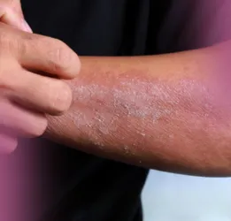 Acanthosis Nigricans