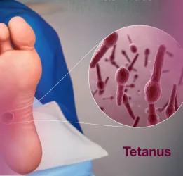 Tetanus Treatment