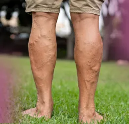 Varicose Veins Treatment