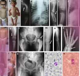 Zellweger Syndrome Treatment