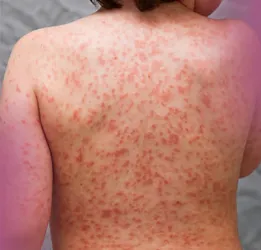 Kawasaki disease Treatment