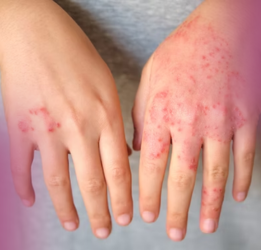 Eczema - SP Medifort Hospital