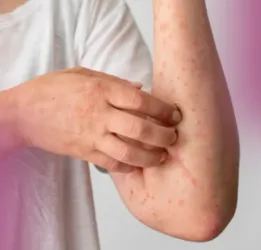Scabies Treatment
