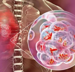 Tuberculosis Treatment