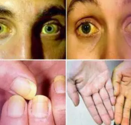 Yellow Fever Treatment