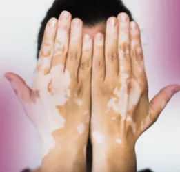 Vitiligo Treatment