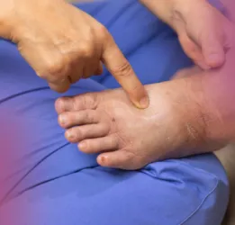 Edema Treatment