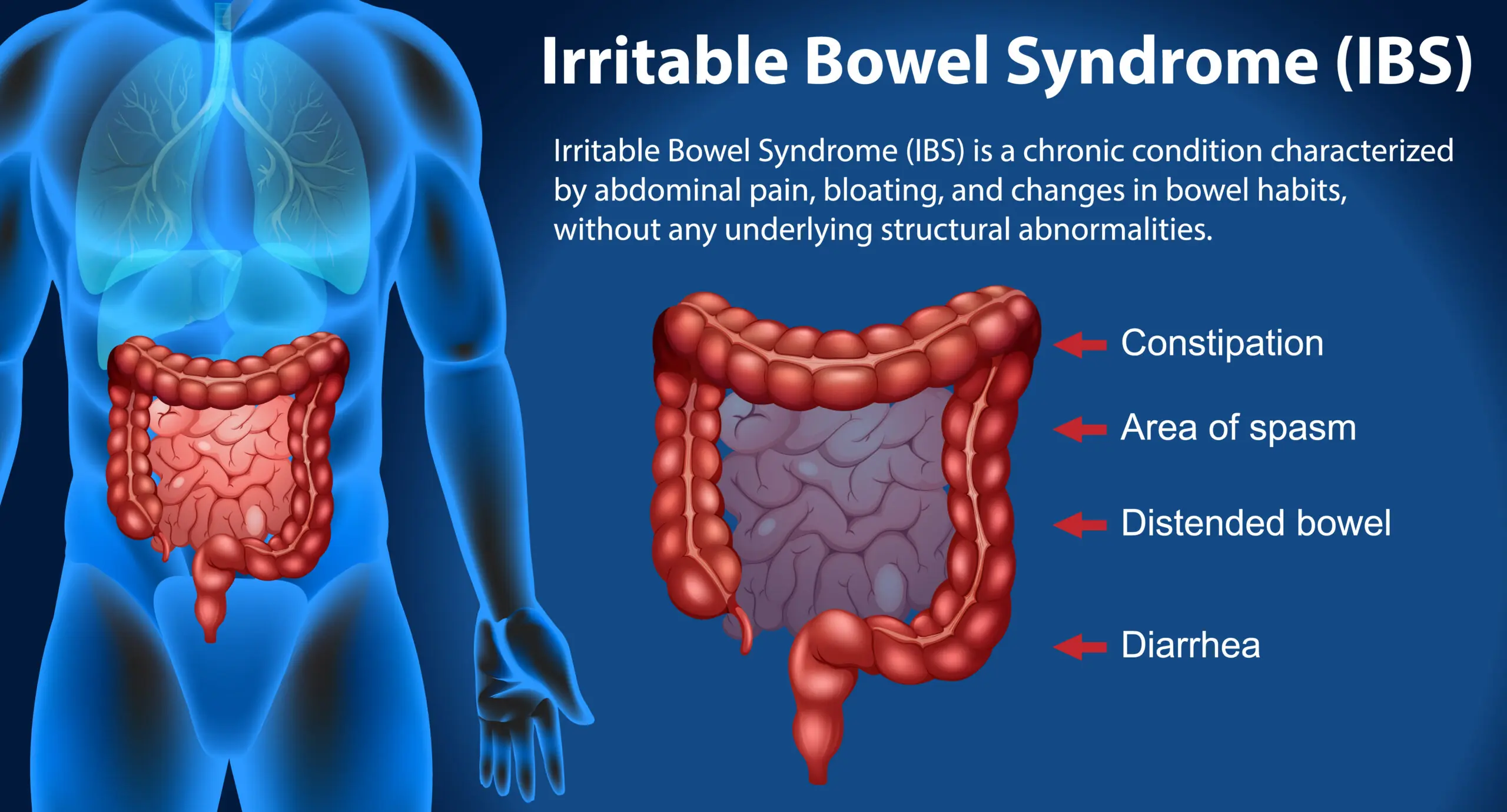 Irritable Bowel Syndrome