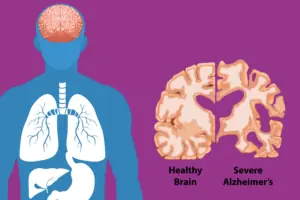 Alzheimer’s Disease Treatment