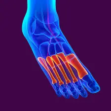 Jones Fracture Treatment