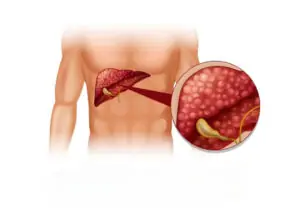 Gallstones Treatment