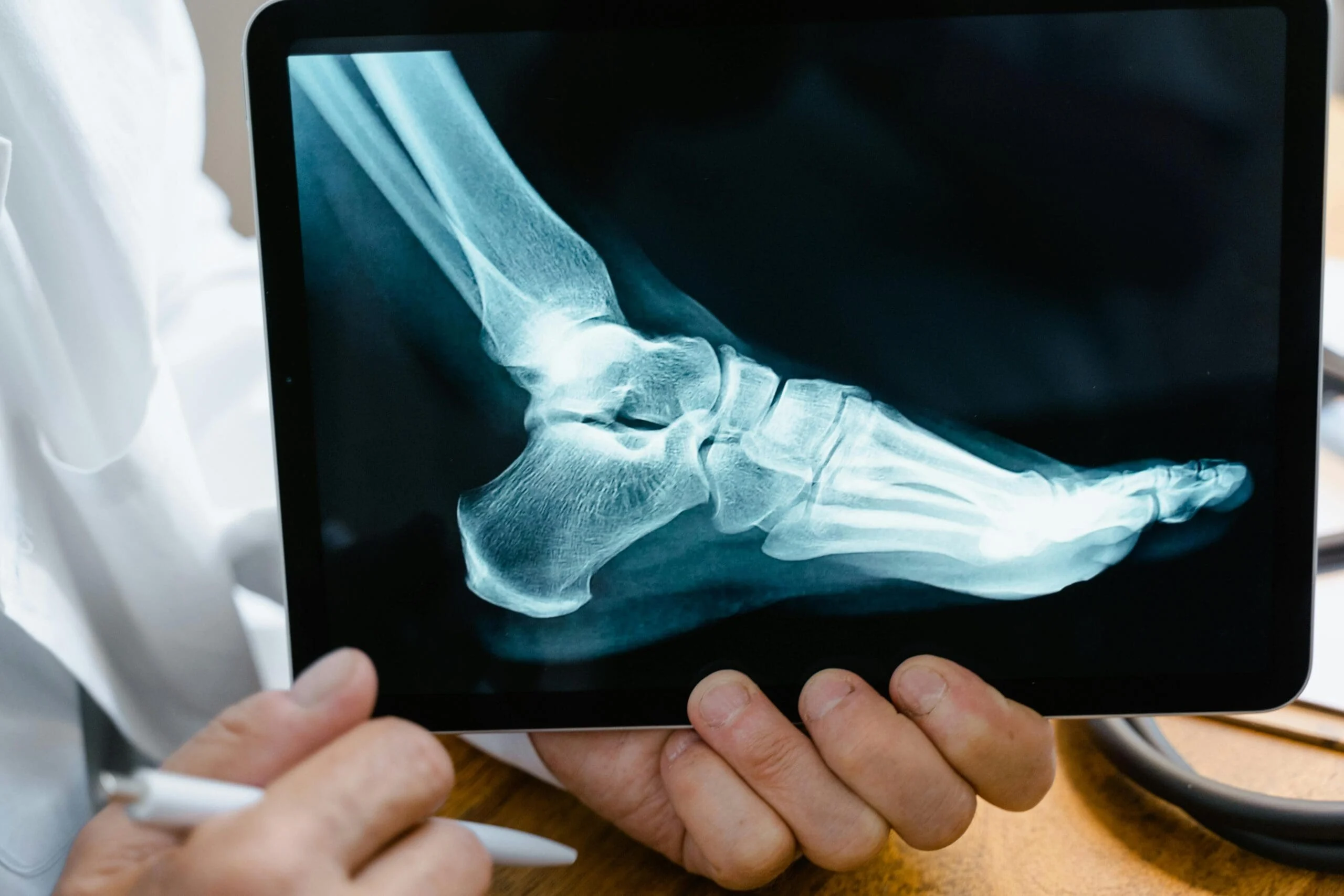 Osteomyelitis Treatment