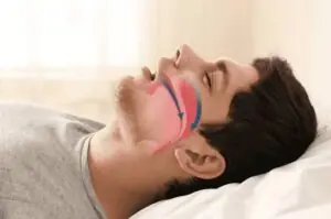 Sleep Apnea Treatment
