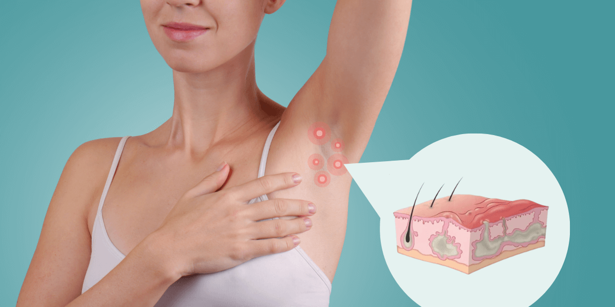 Hidradenitis Suppurativa Treatment