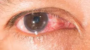 Keratitis Treatment