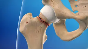 Hip fracture Treatment