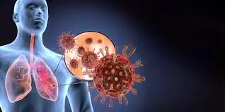 Acute Respiratory Distress Syndrome