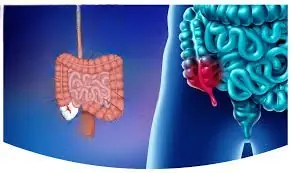 Appendicitis Treatment