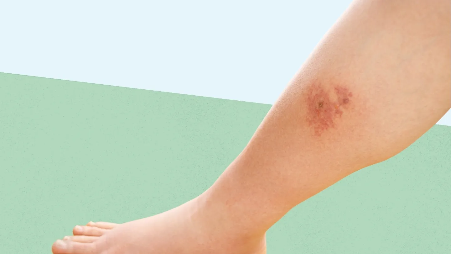 Cellulitis Treatment